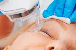 Laser CO2 para a Face: Rejuvenescimento Eficiente e Versátil